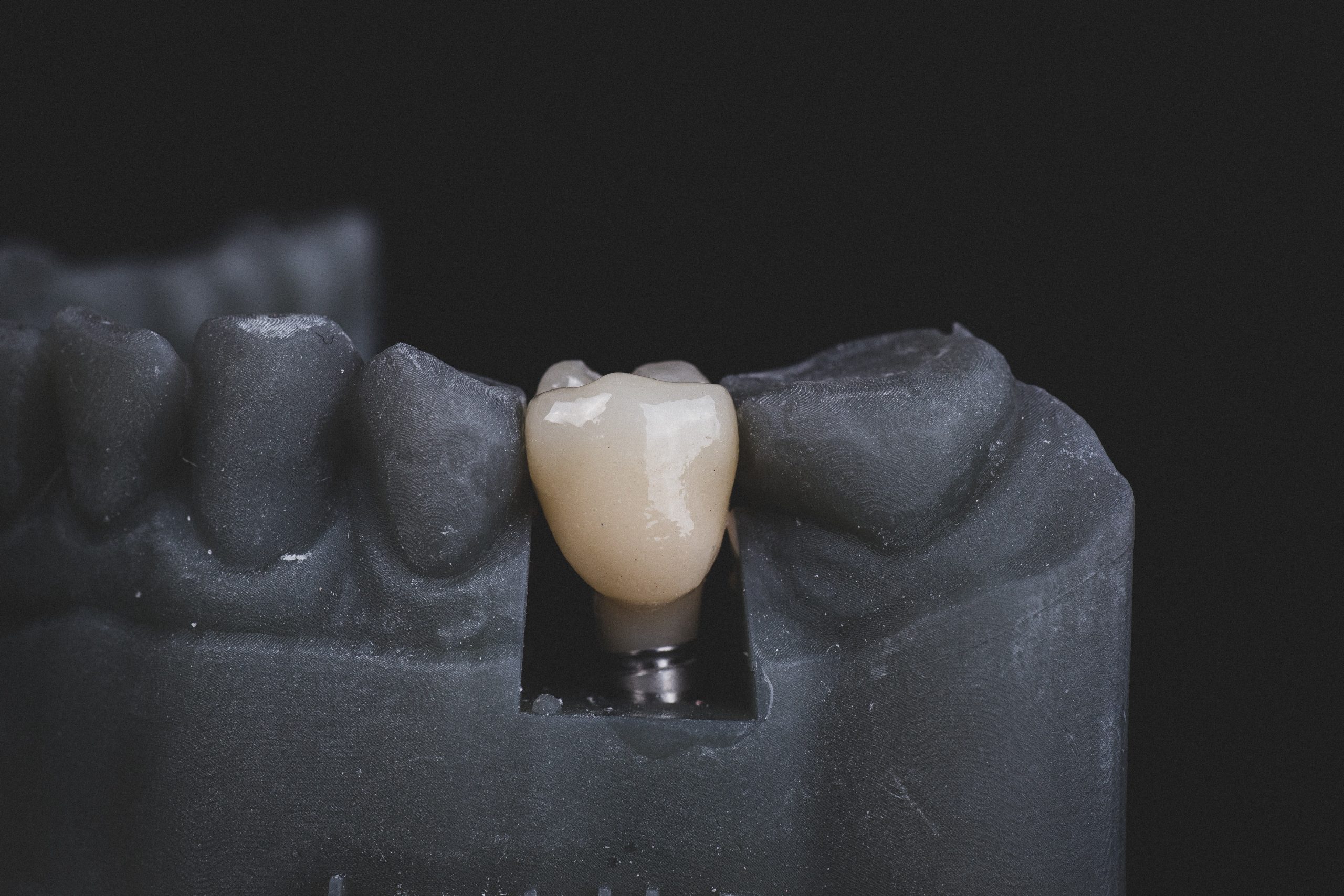 Why Dental Implants Are the Best Solution for Missing Teeth in Woodstock, GA