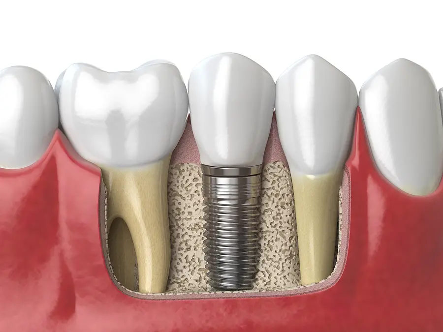 Restore Your Smile with Dental Implants in Woodstock, GA