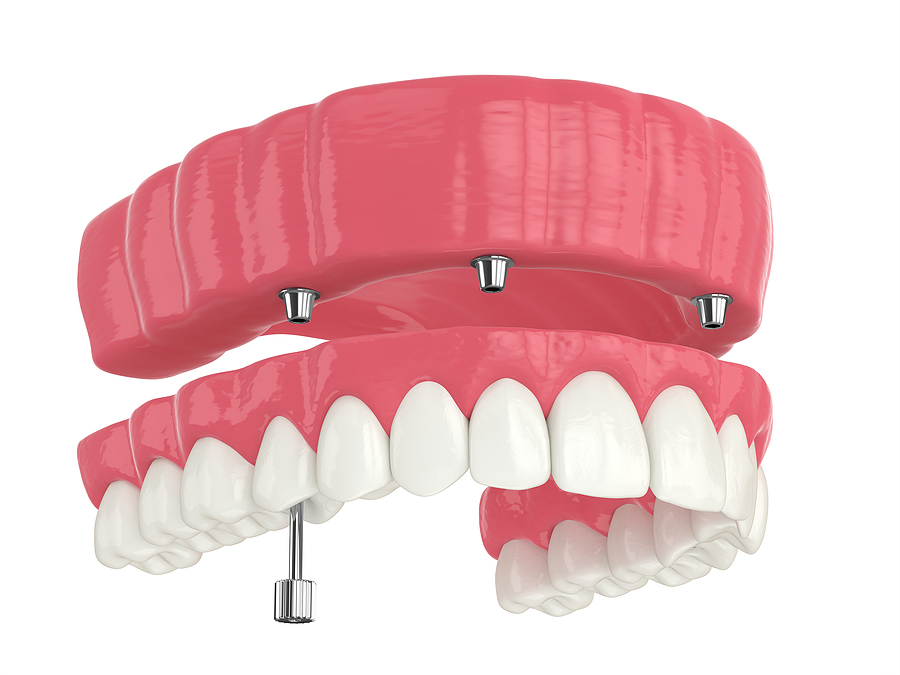 Achieving a Complete Smile with Multiple Dental Implants