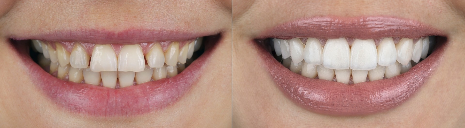 Transform Your Smile with Dental Veneers: A Complete Guide