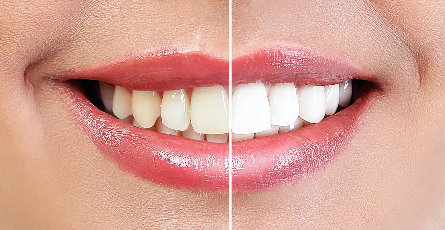 Achieve a Brighter Smile with Professional Teeth Whitening in Woodstock, GA
